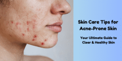 Best Skin care Tips - Dealing with Acne - mygenericmeds.co.in