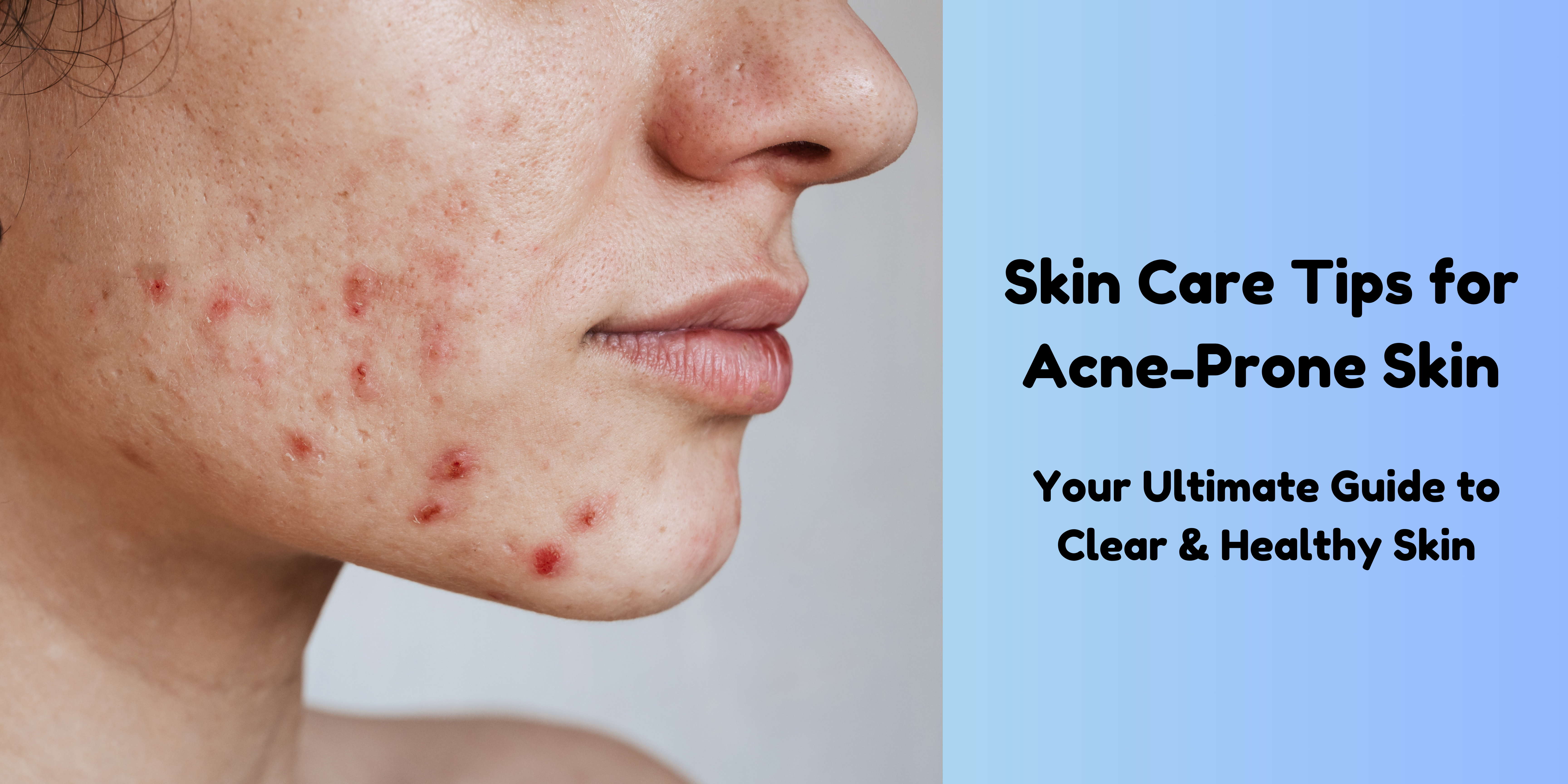 Best Skin care Tips - Dealing with Acne - mygenericmeds.co.in